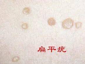 基层特色技术⑥丨液氮冷冻治疗——让这些皮肤病“冷静”一会儿