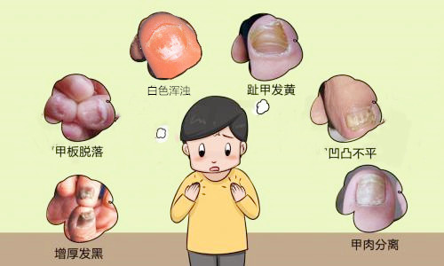 怎样才能治好灰指甲，让指甲健康漂亮？