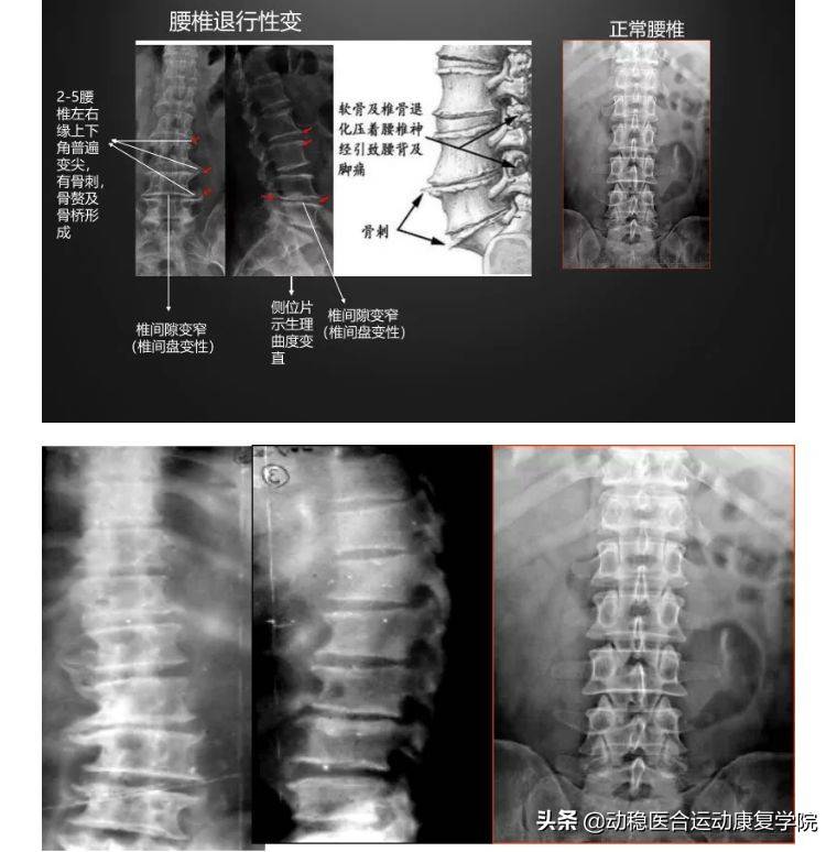 腰痛常见原因——腰椎退行性变的X线片阅读