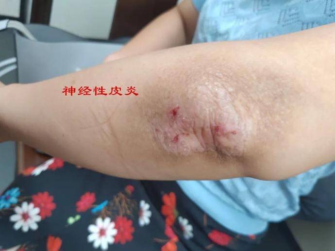 基层特色技术⑥丨液氮冷冻治疗——让这些皮肤病“冷静”一会儿