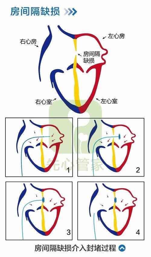 孩子得了房间隔缺损怎么办？