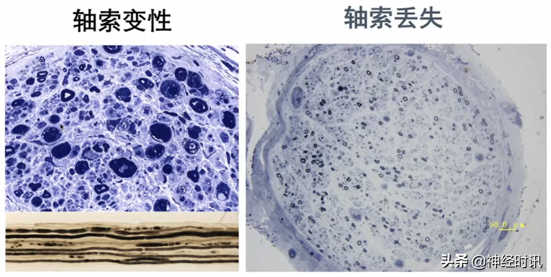 周围神经病的九大诊断步骤，请查收