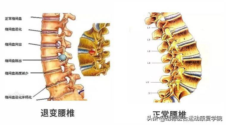 腰痛常见原因——腰椎退行性变的X线片阅读