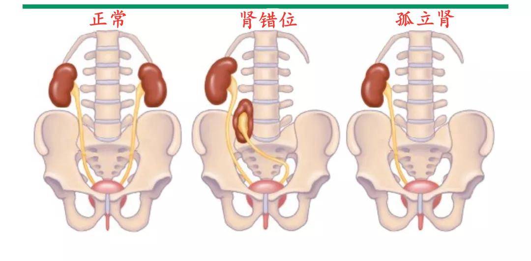 只有一个肾，有什么不好影响吗？怎么保养？来听听肾科医生怎么说