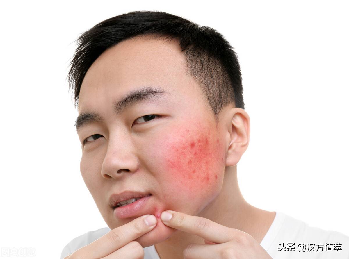 盘点脸上不同部位长痘的原因