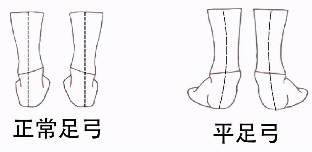 扁平足——有一种痛叫做“脚踏实地”的痛