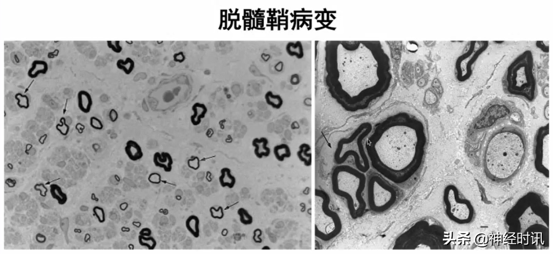 周围神经病的九大诊断步骤，请查收