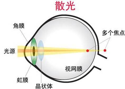 眼睛散光要戴眼镜吗？学会这三种方法，症状轻松改善