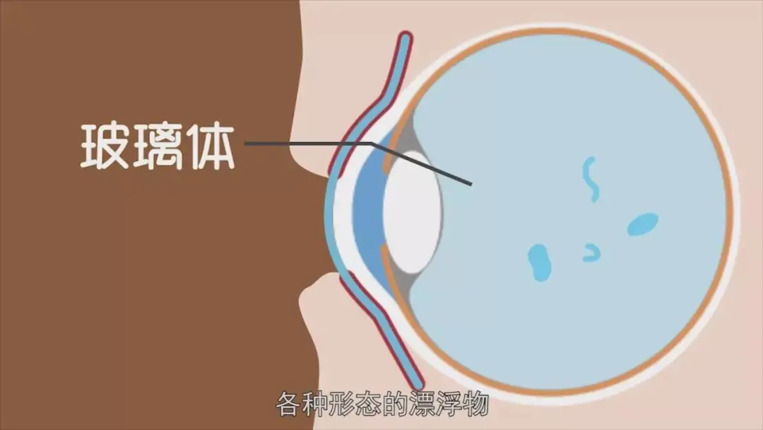 眼前总有“蚊子”飞来飞去，用手抓又抓不住，小心飞蚊症找上门