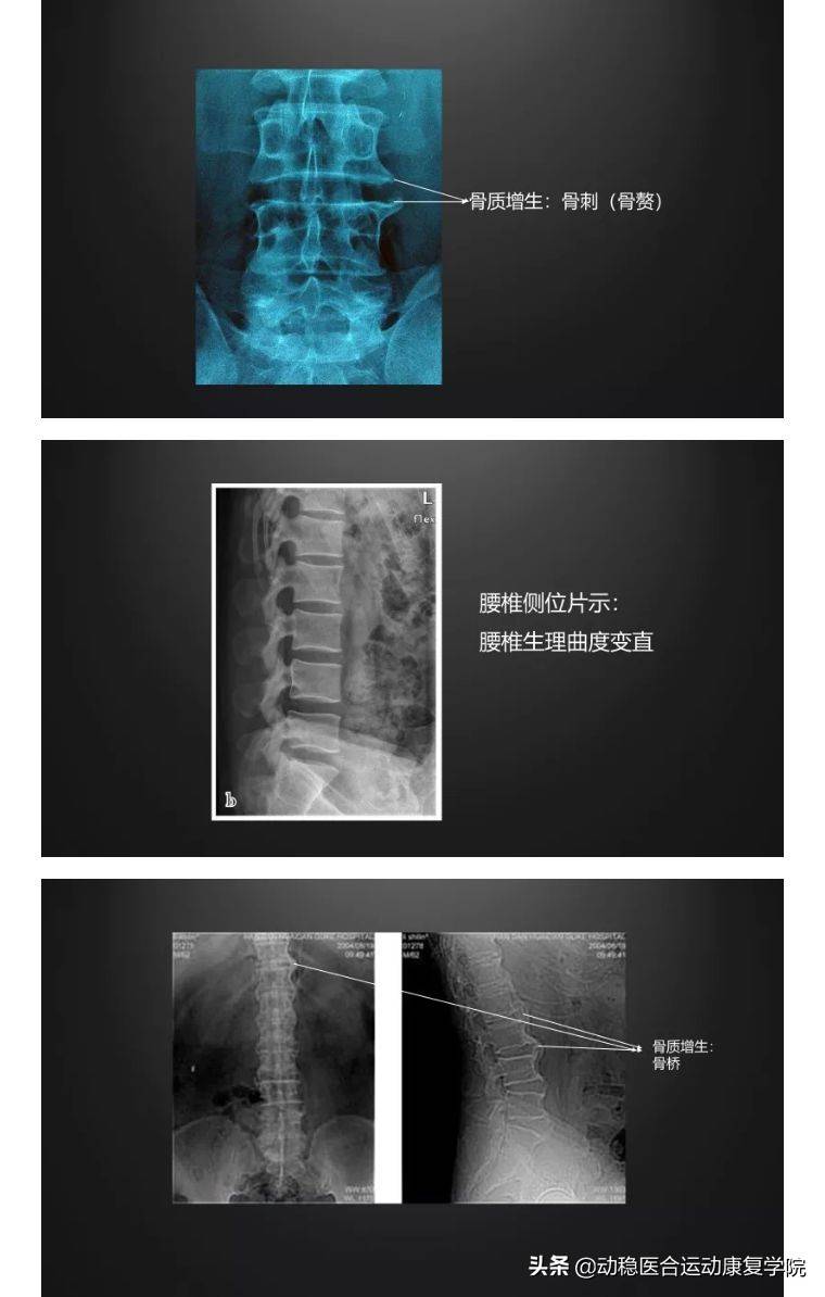 腰痛常见原因——腰椎退行性变的X线片阅读