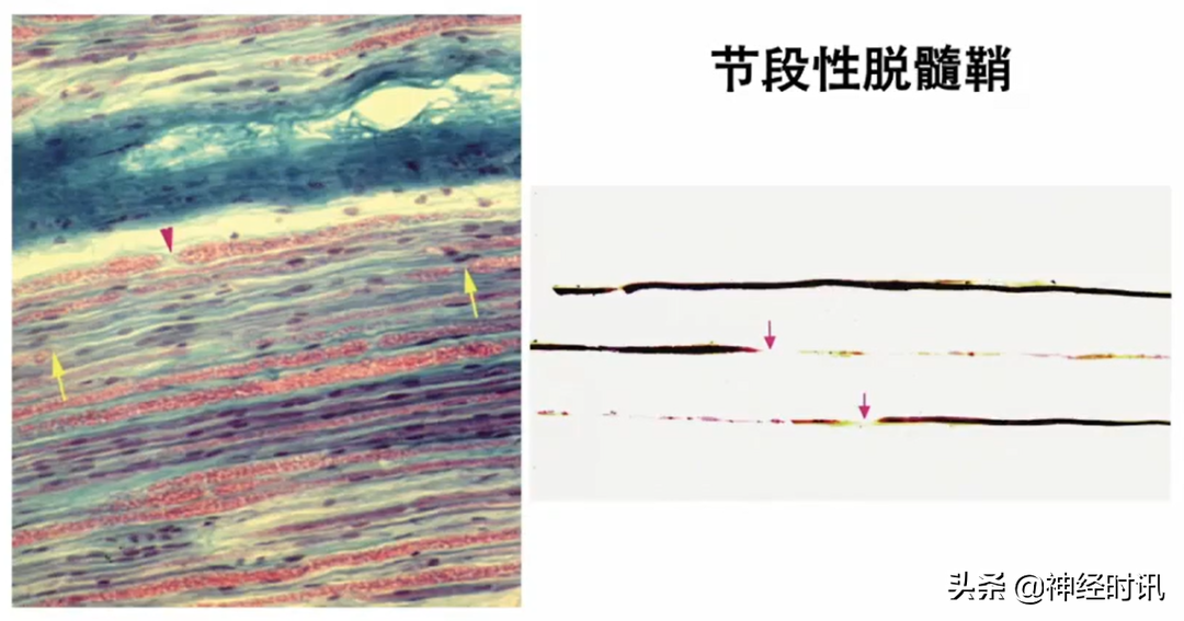 周围神经病的九大诊断步骤，请查收