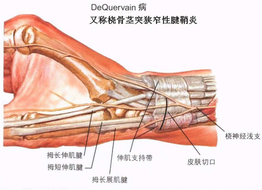 拇腱鞘炎的治疗