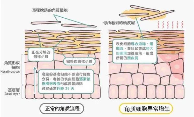 洗发水都搞不定的头皮屑，还能抢救一下吗？