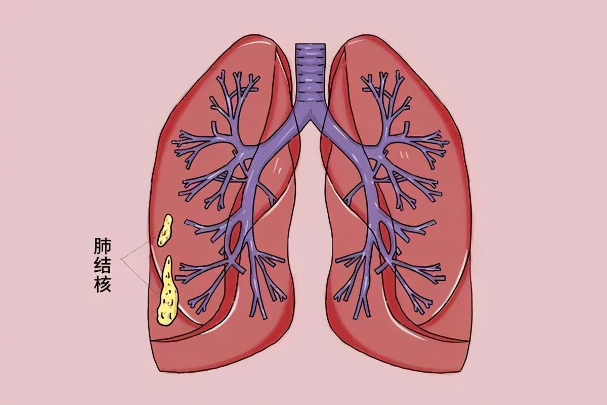 什么是肺纹理增粗，严不严重？医生做出全面分析，或能让你放心