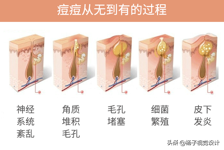 脸上长痘痘是因为什么原因引起的？怎么才能把脸洗干净？（图片）