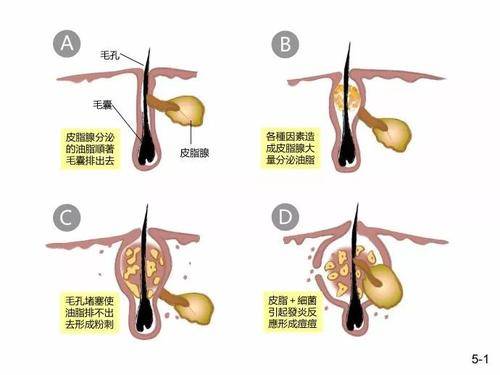 你鼻子上的黑头怎么形成的，你了解多少呢？