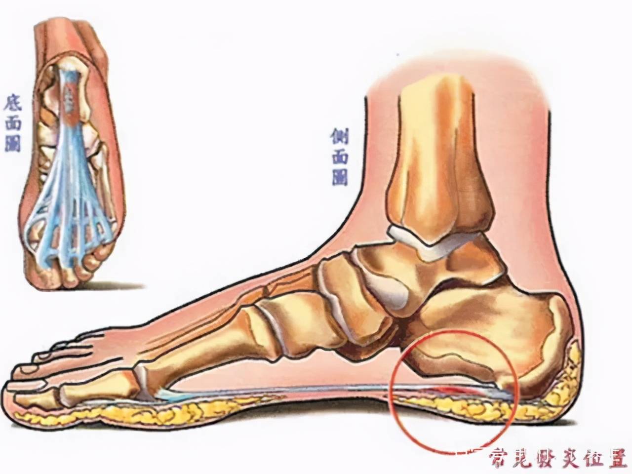 为什么脚跟疼？这些招数缓解90%足跟痛