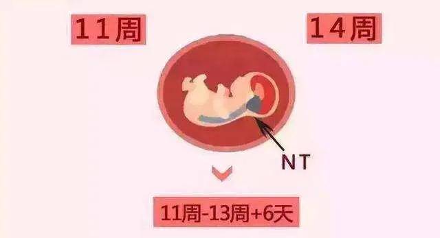 专业的产科科普：产检NT是什么？超标怎么办？