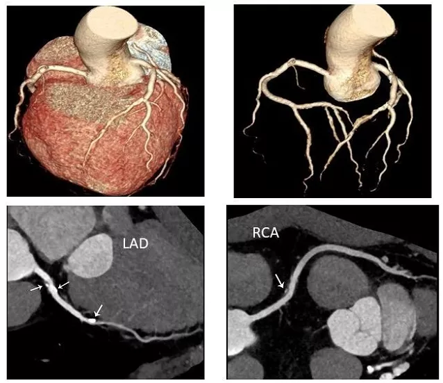 冠脉CTA天天看，你真的懂它吗？