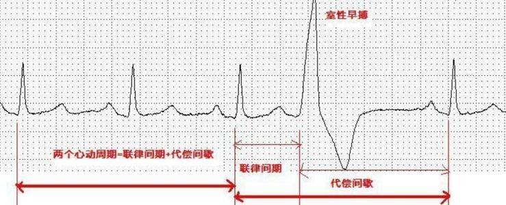 心脏室性早搏，有什么症状？如何治疗？医生全都告诉你