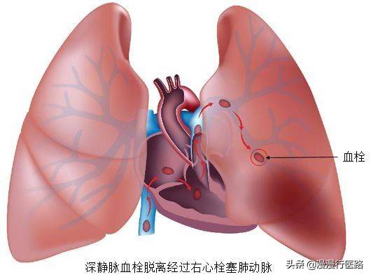 关于肺血栓栓塞症你了解多少呢？第一步先从预防做起