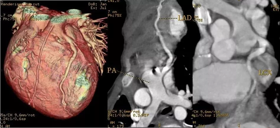 冠脉CTA天天看，你真的懂它吗？