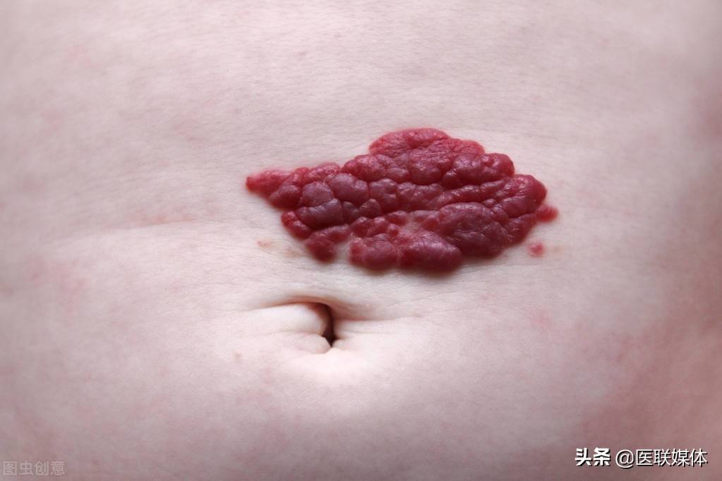 皮肤上长了小肉疙瘩、黑色痣是怎么回事？与疾病有关系吗？