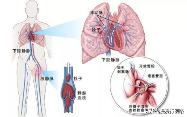 关于肺血栓栓塞症你了解多少呢？第一步先从预防做起