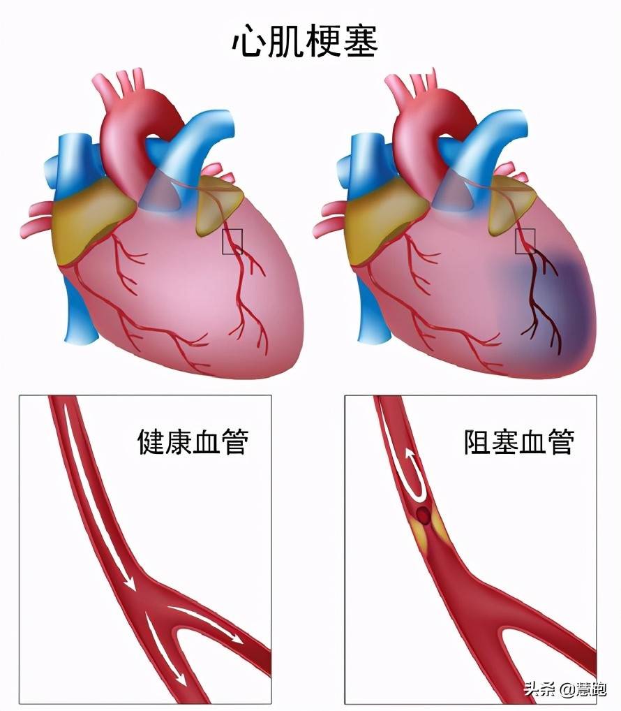 ​“板蓝根大王”心梗过世：运动可以防治哪些疾病？