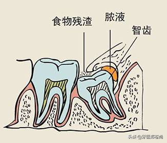 拔完智齿后吃饭有忌口吗？患者有两颗阻生智齿