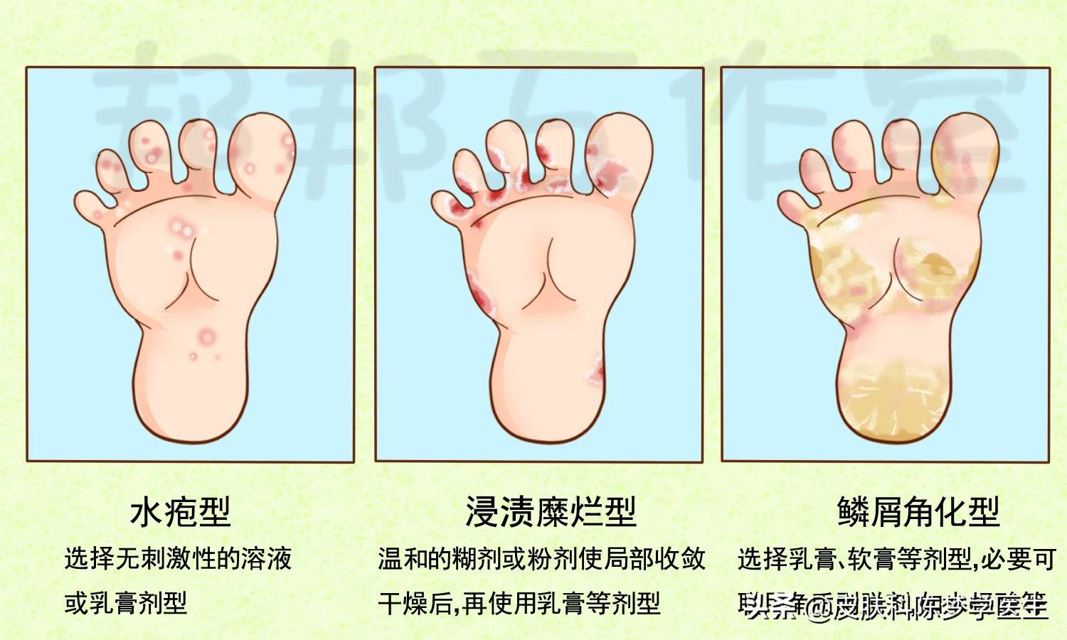 要想治好顽固反复的脚气，一定要选择最合适的药膏