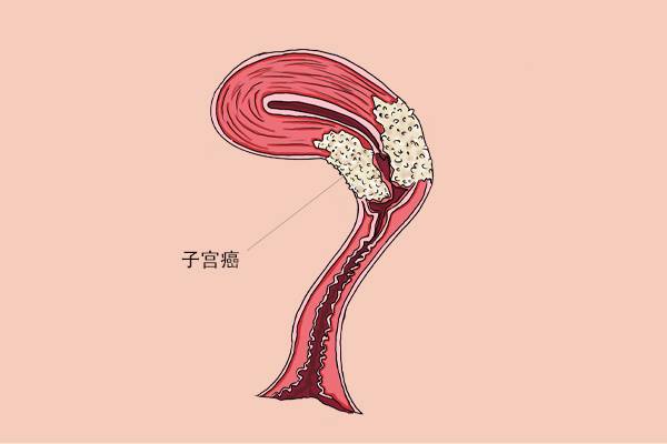 女人切除子宫后，会迅速变老吗？3个改变，很多女性难以接受