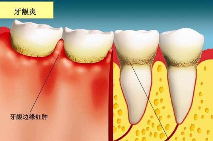牙龈反复发炎、肿痛要警惕！可能是得了这种病
