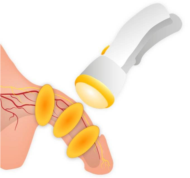 「勃起功能障碍」可以做这种康复治疗，再不了解就晚了