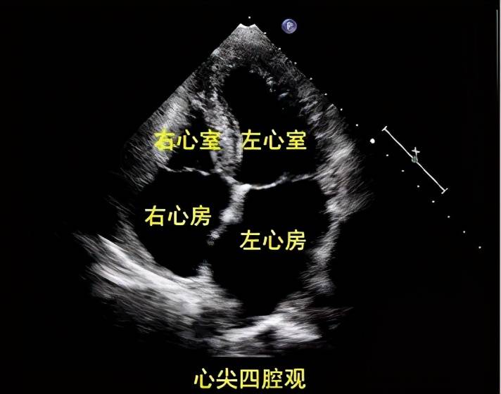 吃了这颗“定心丸”！郴州市第一人民医院为您解析心脏彩超