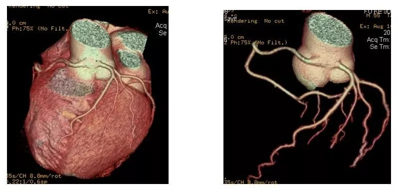 冠脉CTA天天看，你真的懂它吗？