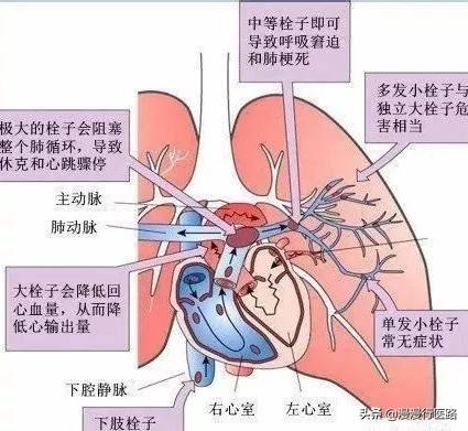 关于肺血栓栓塞症你了解多少呢？第一步先从预防做起