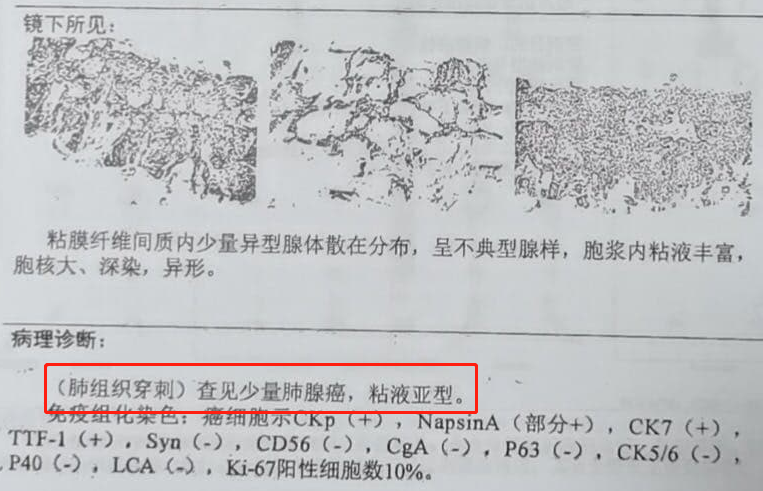 靶向药是肺癌病人的“救命稻草”，目前有哪些选择？一文列全了