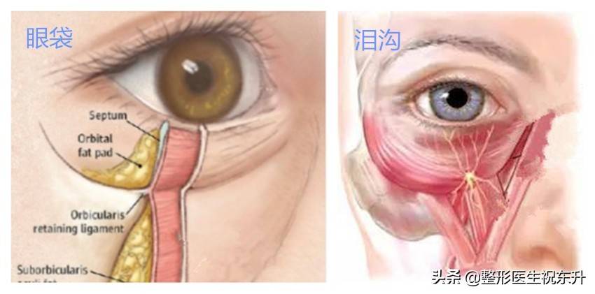 别随便做“眶隔脂肪释放”祛眼袋手术，否则会“后悔”#