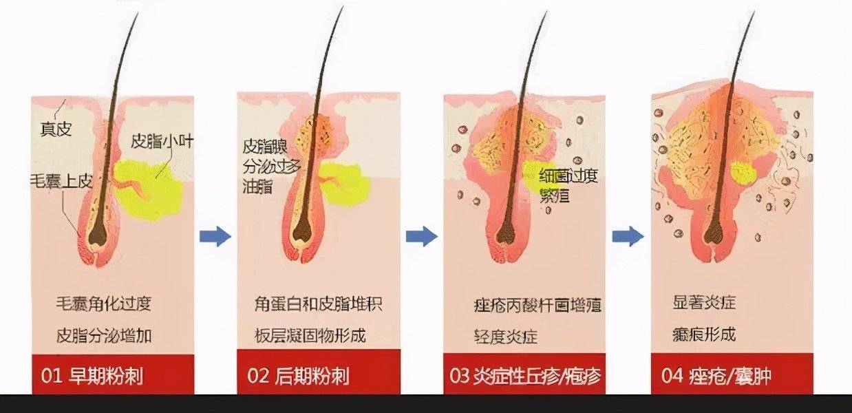 脸上长痘是生病了？竟然是因为这个原因