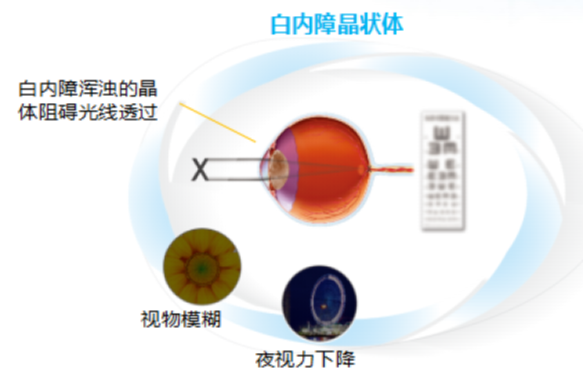 白内障到底是怎么回事，其实很简单，看完这篇科普都能懂