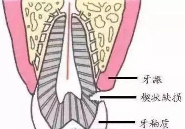 到底为什么要做根管治疗？
