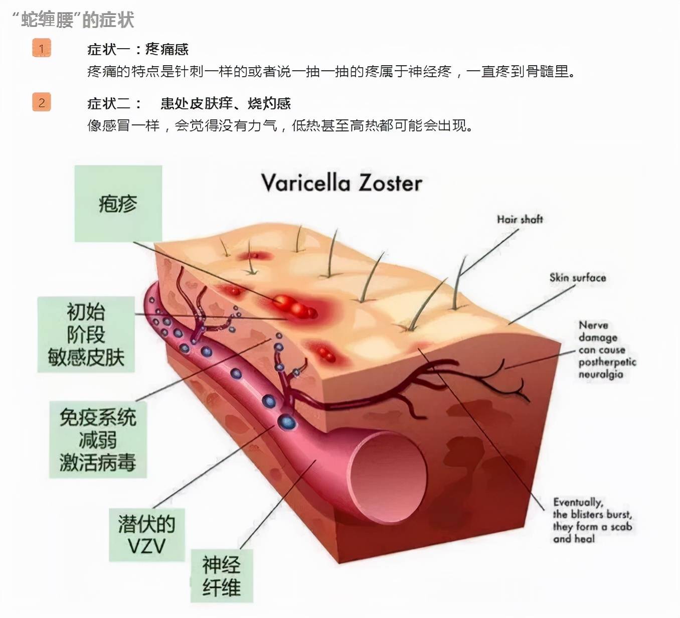 蛇缠腰“缠一圈”会死人？带状疱疹是怎么回事？这7类人要注意