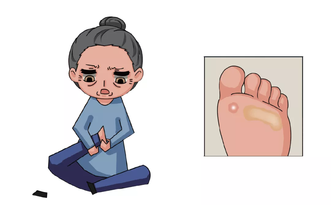 @糖友们：鸡眼和老茧别再傻傻分不清