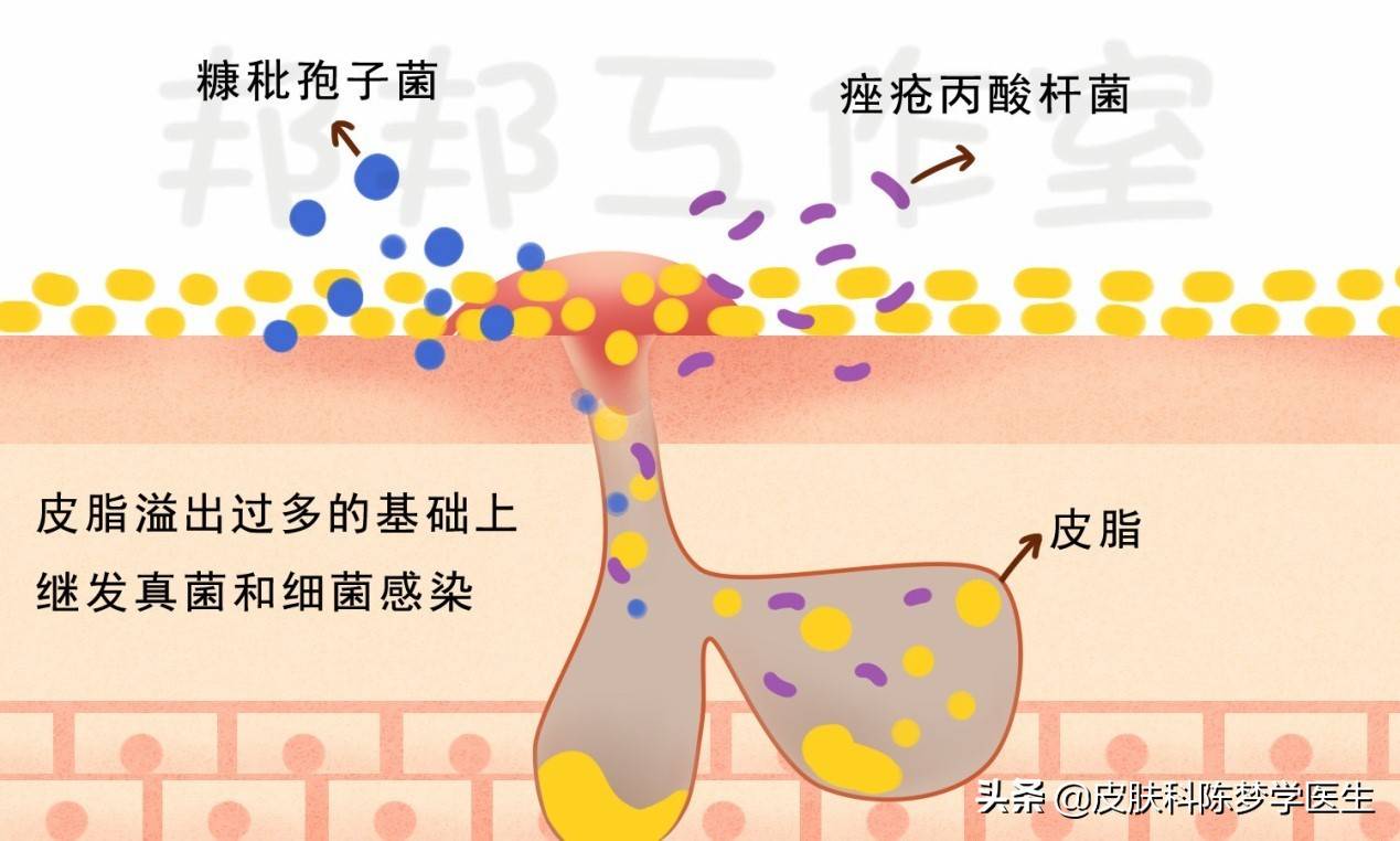 脸部脱皮？泛红？得了脂溢性皮炎该怎么办？