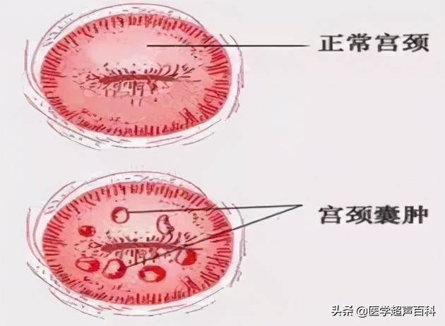 体检时发现宫颈囊肿，忧心忡忡，害怕影响日后的身体健康及生活