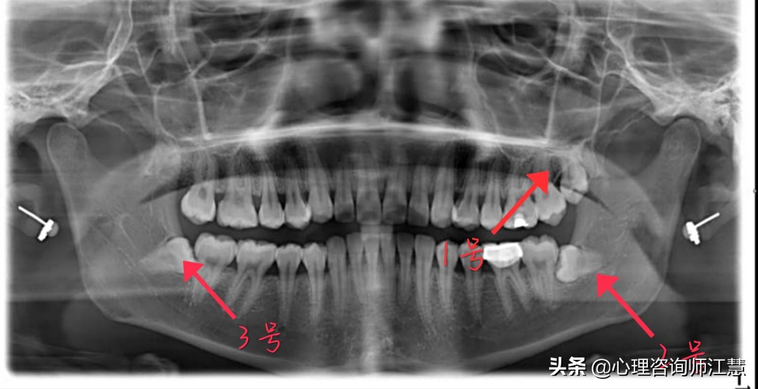 拔智齿实录篇——附上一些些挂号和放松Tips