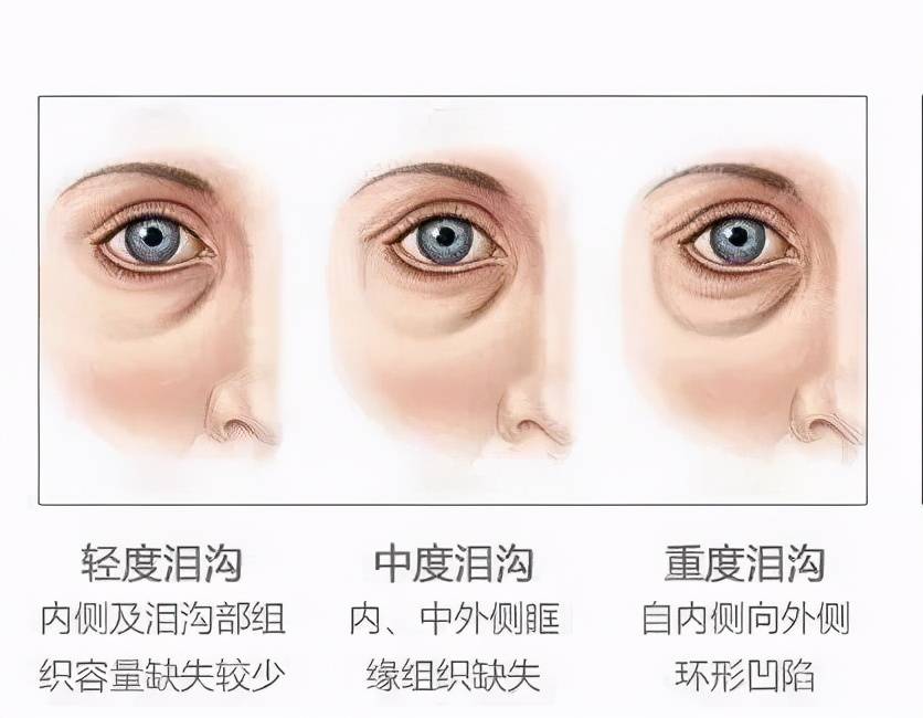 卧蚕、眼袋和泪沟有啥区别？这篇都说清楚了