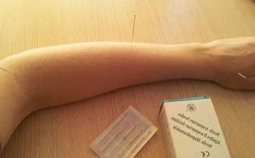 针灸美容的原理分析