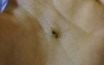 宝宝脸上被蚊子咬了该怎么办